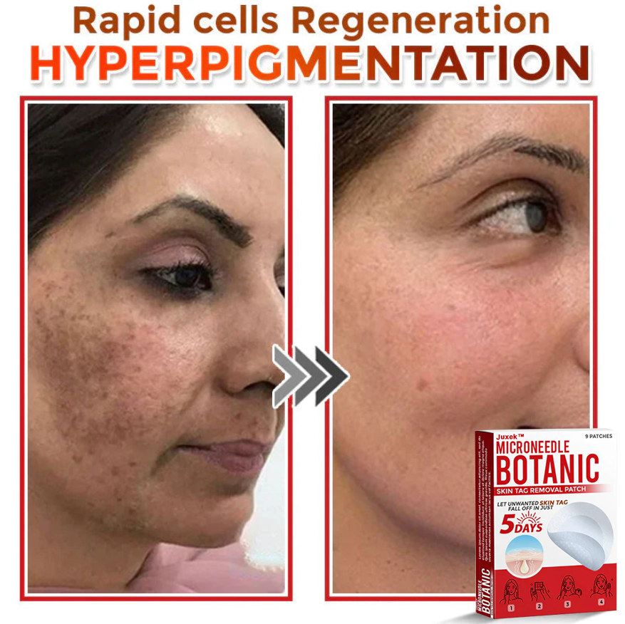 Juxek™ Removal Patch: Gentle Microneedle Patches for Skin Tag & Mole Removal