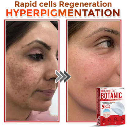 Juxek™ Removal Patch: Gentle Microneedle Patches for Skin Tag & Mole Removal