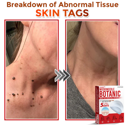 Juxek™ Removal Patch: Gentle Microneedle Patches for Skin Tag & Mole Removal